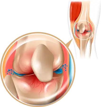 Gelenkunterstützung Technologie Artrorevival - Mehrstufige Formel